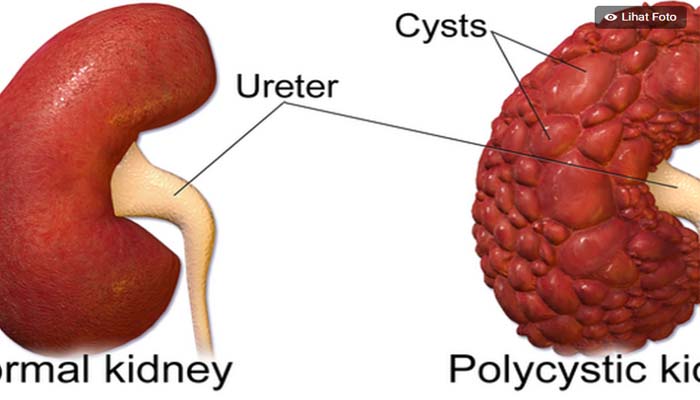 Penyakit Ginjal Polikistik yang Bisa Akibatkan Gagal Organ